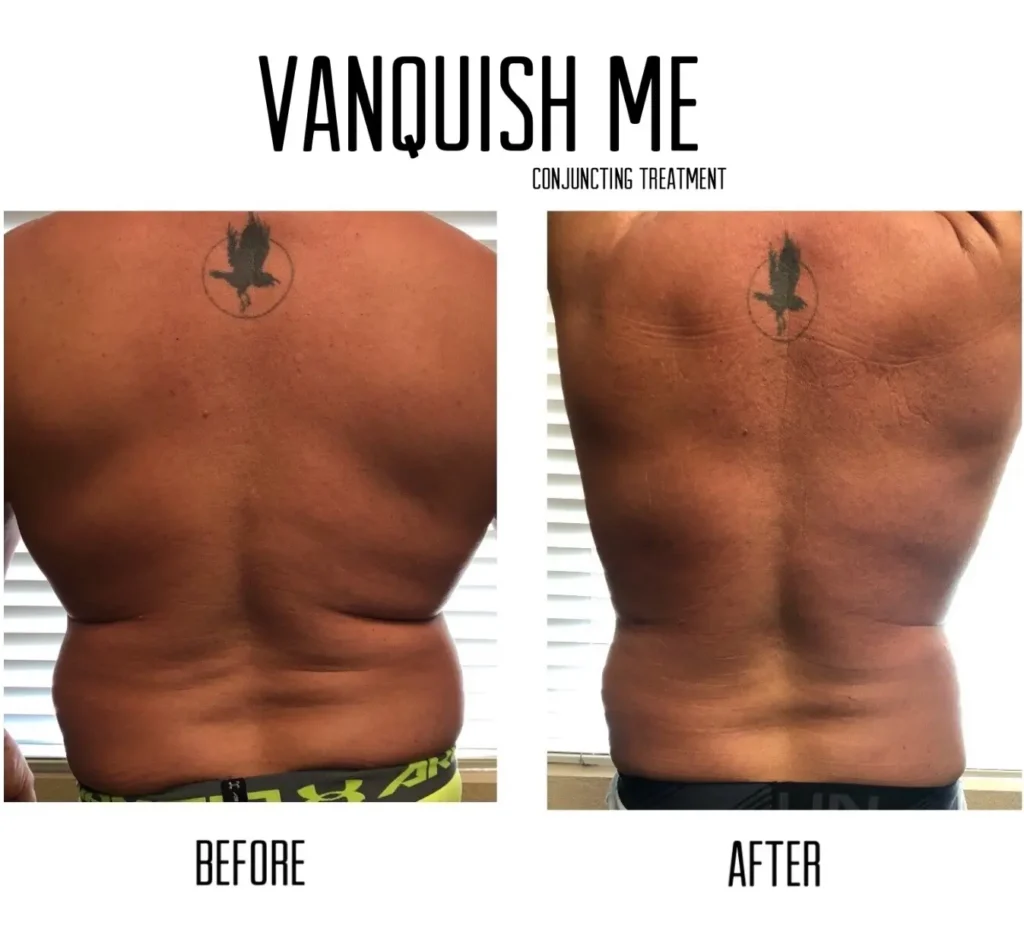 Vanquish ME – Non-Invasive Body Sculpting Treatment