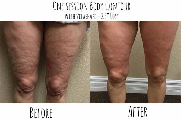 A woman's legs before and after a one session cellulite reduction treatment.