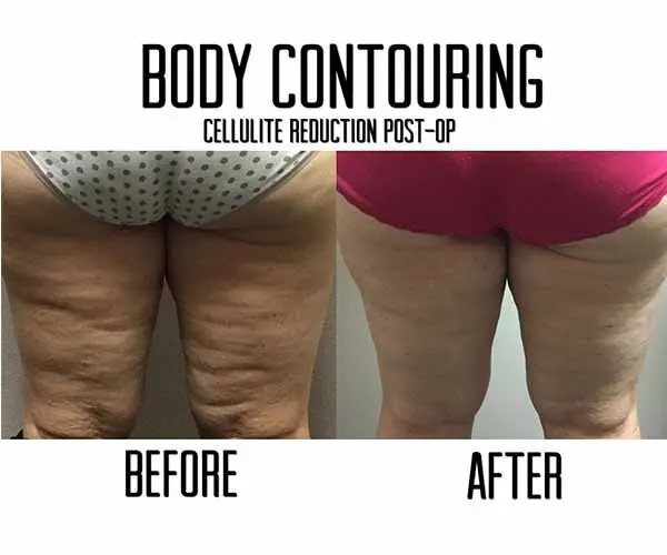 Cellulite reduction and body contouring transformation.