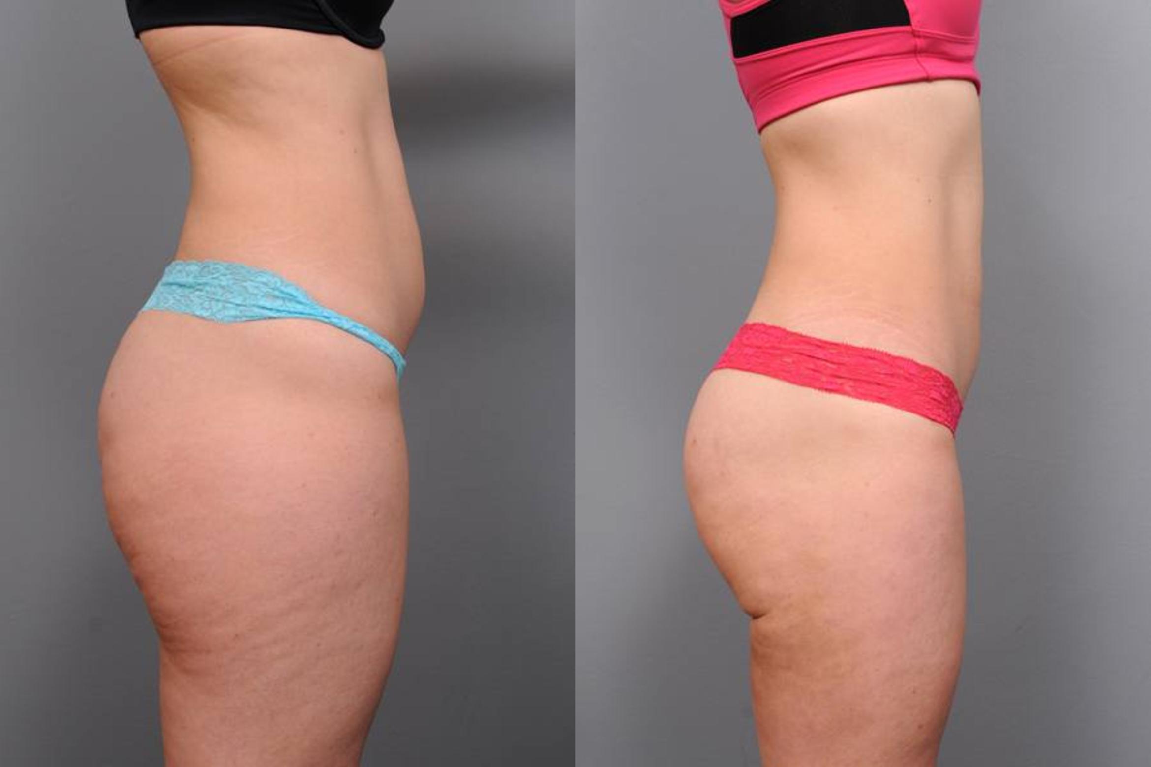 Get Rid of Stomach Fat with Smartlipo Laser Liposuction