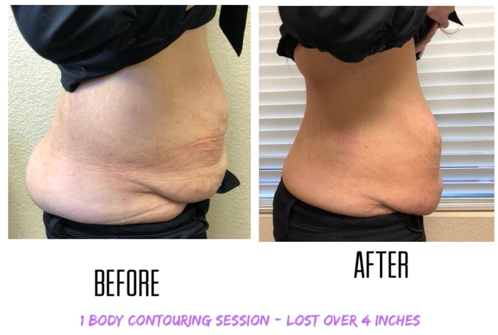 Flank Fat Removal with Velashape  Non-surgical Body Contouring Las Vegas NV